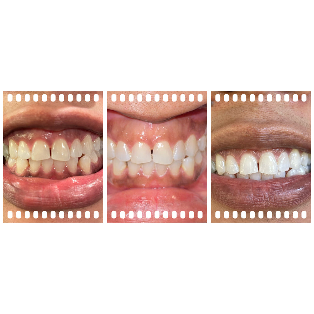 80 MINUTE (SENSITIVE) WHITENING